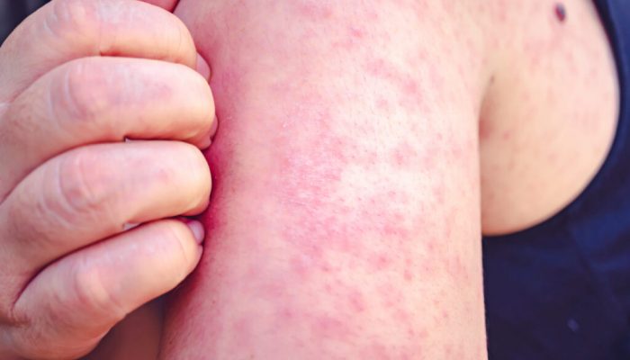 Possible measles exposures at Sunport; other locations from traveler cases